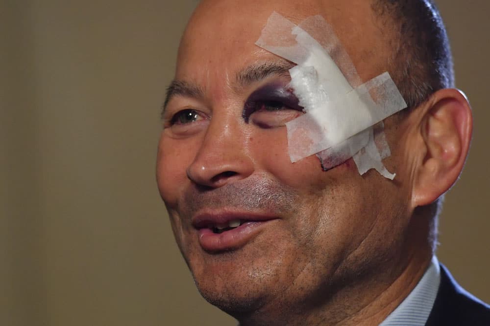 Eddie Jones couldn't keep his story straight on what happened to his face. Photo: AFP